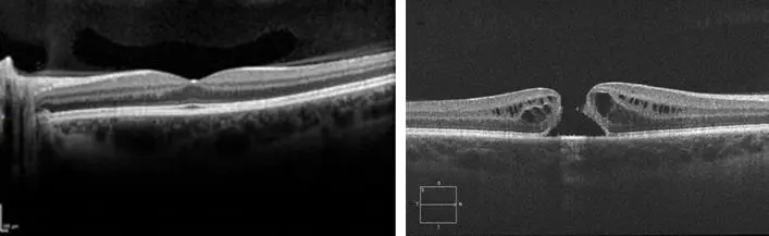 agujero macular