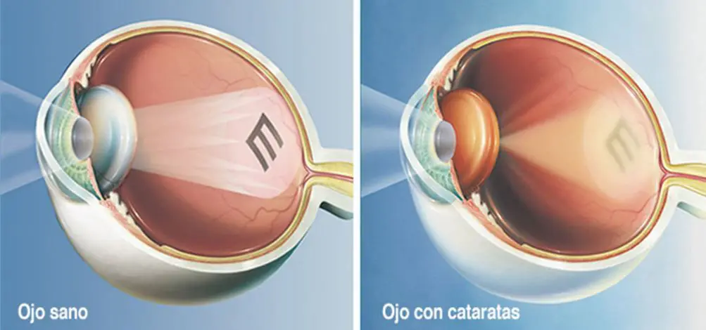 catarata