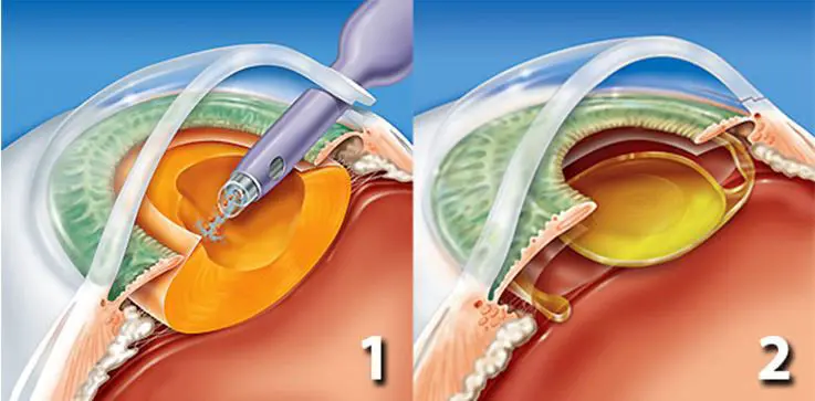 facoemulsificaicón