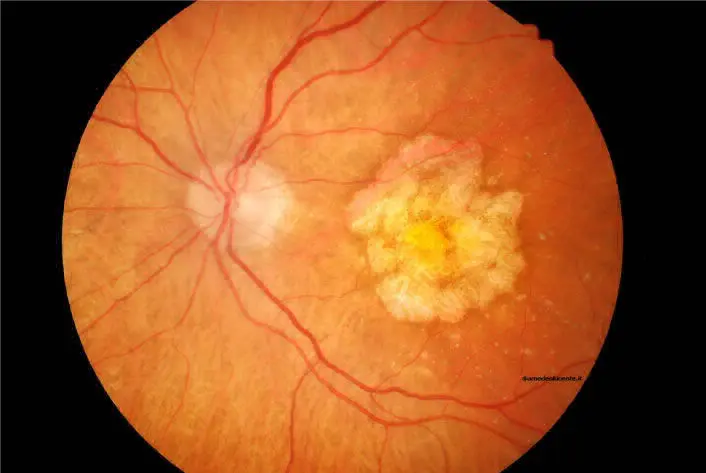 TRATAMIENTO PARA MACULOPATÍAS