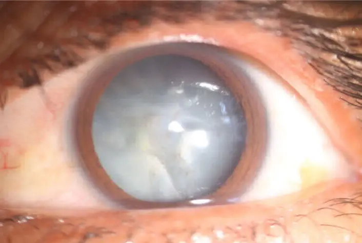 Cirugía de Cataratas