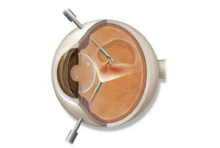 CIRUGÍA DE RETINA CON VITRÉCTOMO STELLARIS